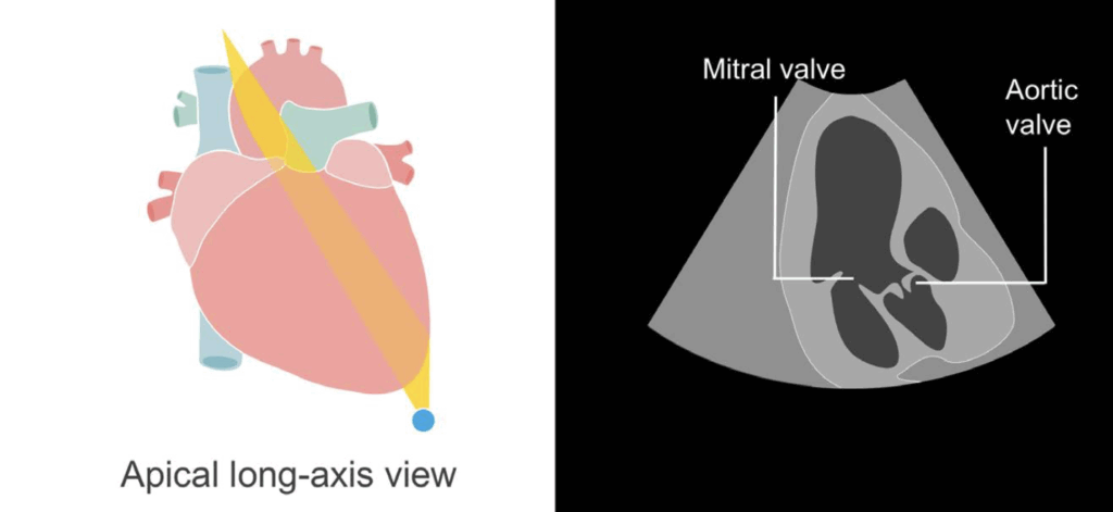 Apical long-axis view